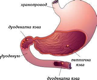 Сравнение на синдрома на Малори Вайс с разширени вени на хранопровода, язва на стомаха и дванадесето